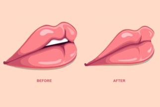 Lip-Reduction